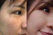 以伊屏清斑效果如何？（一种祛除皮肤斑点的新方法）